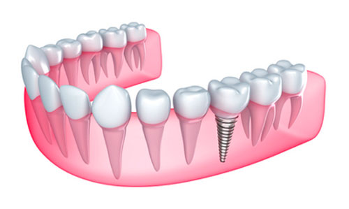CAN I GET DENTAL IMPLANTS IF I HAVE PERIODONTAL DISEASE?