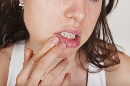 DO COLD SORES AFFECT YOUR ORAL HEALTH?